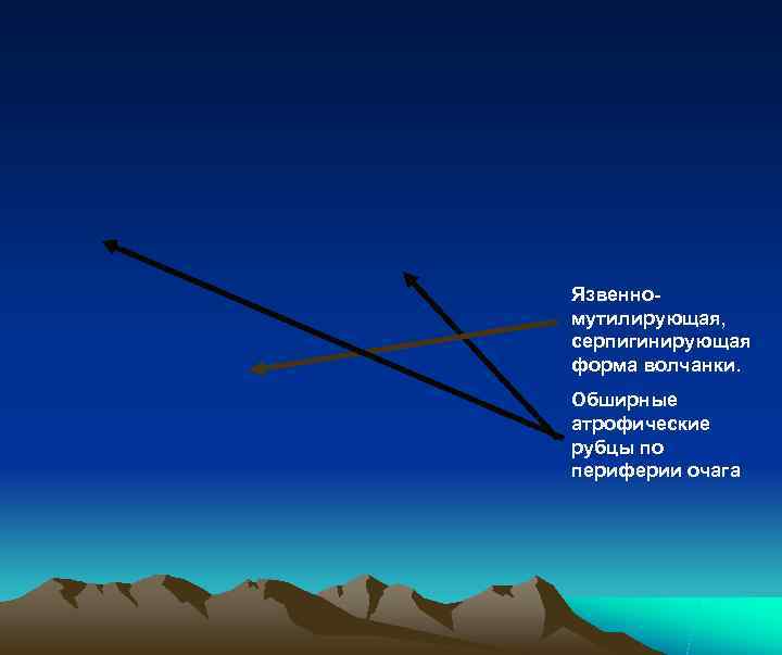 Язвенно- мутилирующая, серпигинирующая форма волчанки. Обширные атрофические рубцы по периферии очага 