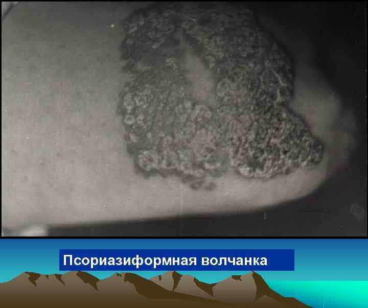 Псориазиформная волчанка 