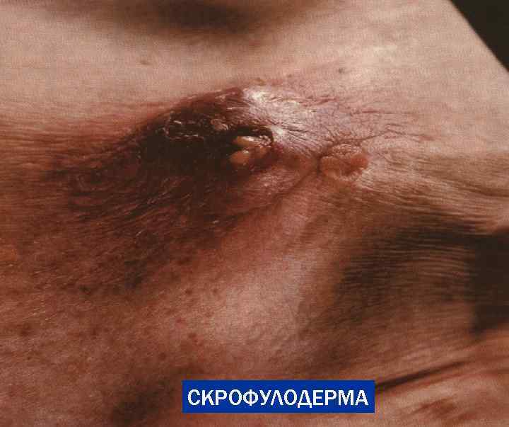 СКРОФУЛОДЕРМА 