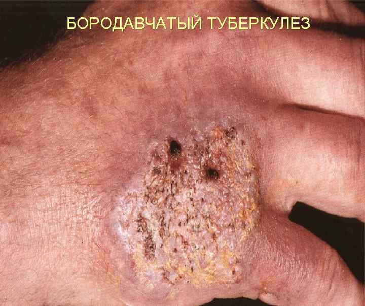 БОРОДАВЧАТЫЙ ТУБЕРКУЛЕЗ 