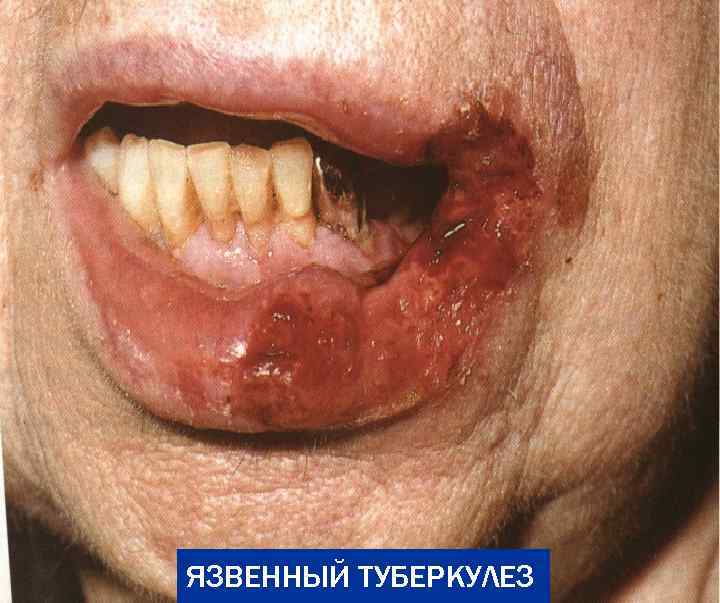ЯЗВЕННЫЙ ТУБЕРКУЛЕЗ 