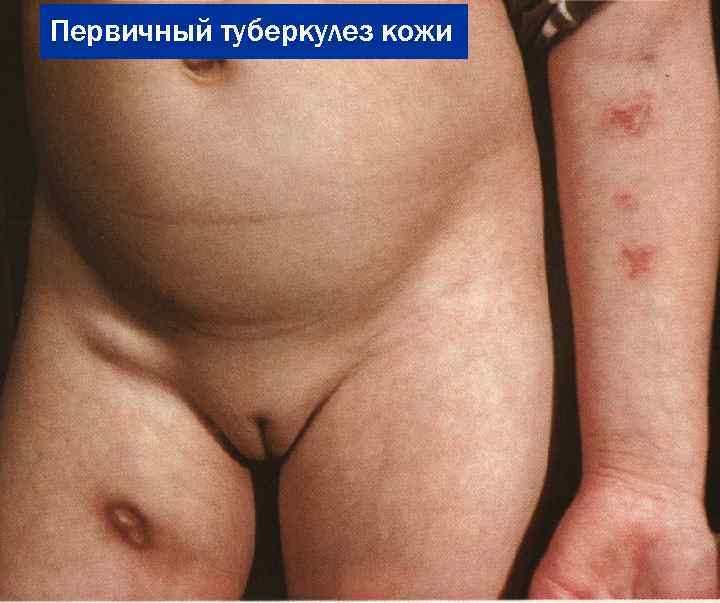Первичный туберкулез кожи 