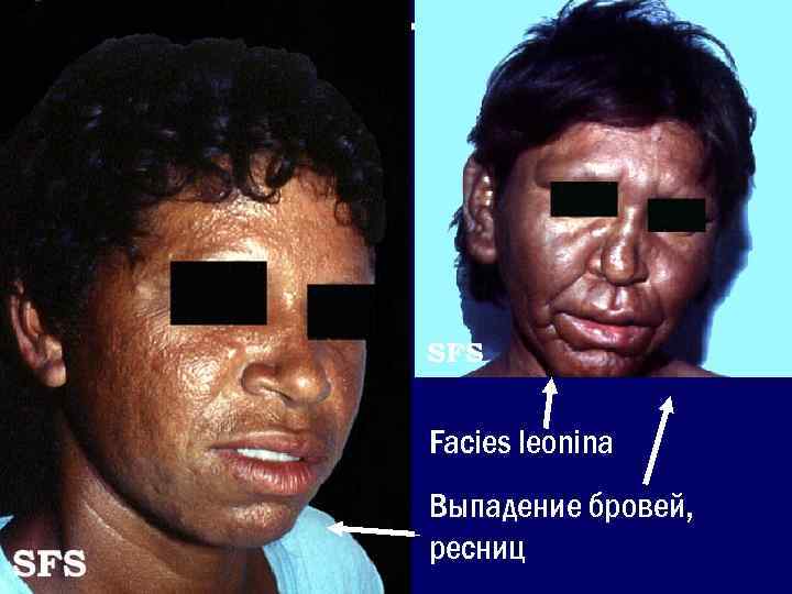 Facies leonina Выпадение бровей, ресниц 
