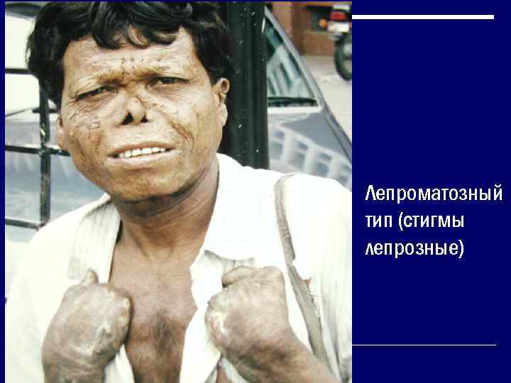 Лепроматозный тип (стигмы лепрозные) 