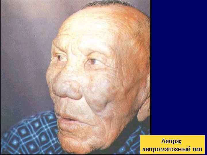  Лепра; лепроматозный тип 