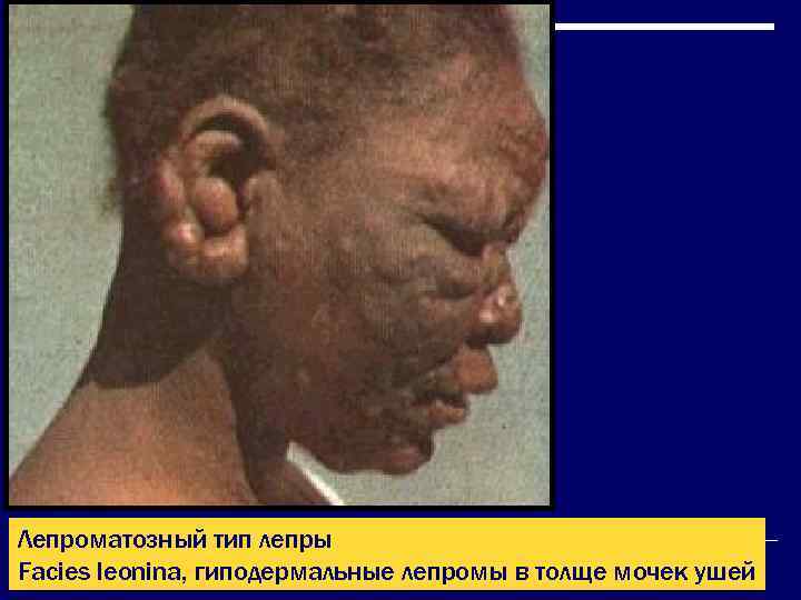Лепроматозный тип лепры Facies leonina, гиподермальные лепромы в толще мочек ушей 