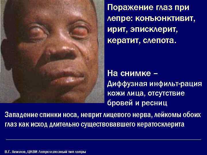     Поражение глаз при     лепре: конъюнктивит, 