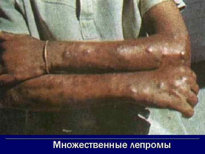 Множественные лепромы 