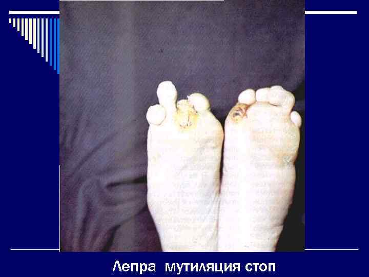 Лепра; мутиляция стоп 