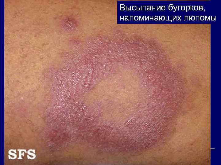 Высыпание бугорков, напоминающих люпомы 