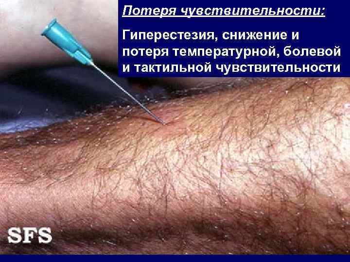 Потеря чувствительности: Гиперестезия, снижение и потеря температурной, болевой и тактильной чувствительности 