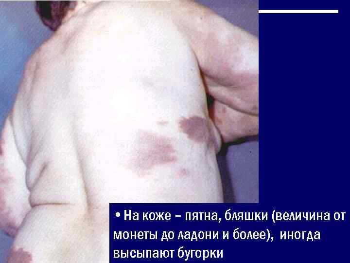  • На коже – пятна, бляшки (величина от монеты до ладони и более),