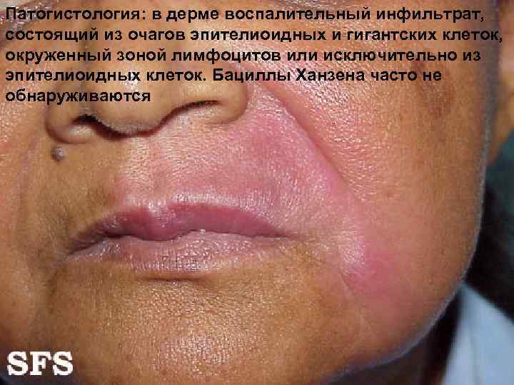 Патогистология: в дерме воспалительный инфильтрат, состоящий из очагов эпителиоидных и гигантских клеток, окруженный зоной