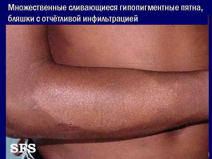 Множественные сливающиеся гипопигментные пятна, бляшки с отчётливой инфильтрацией     Недифференцированный тип