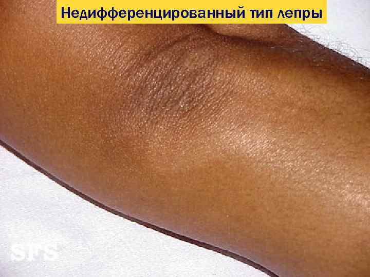 Недифференцированный тип лепры 