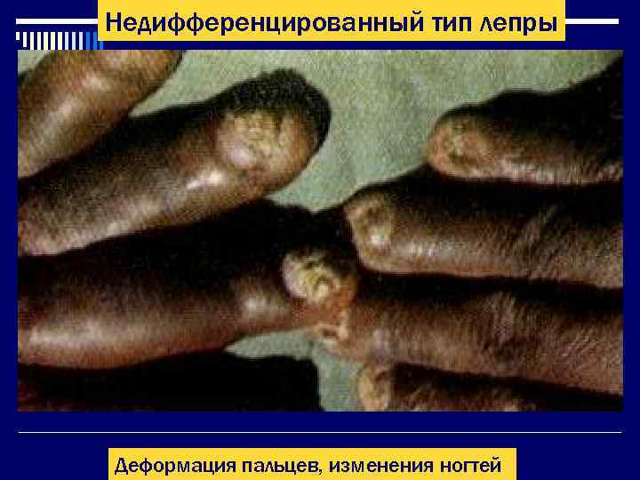 Недифференцированный тип лепры Деформация пальцев, изменения ногтей 
