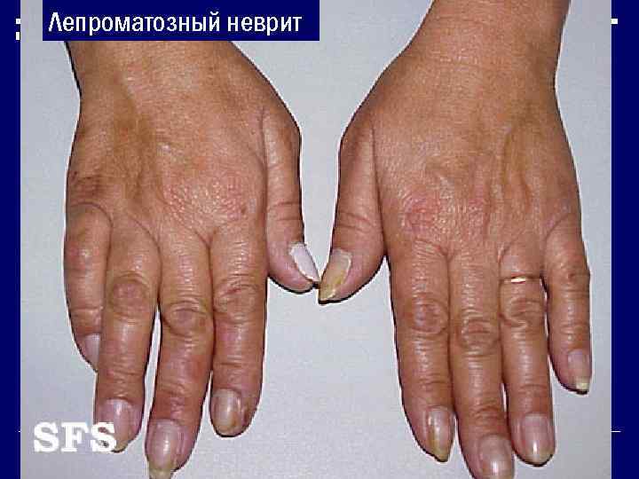 Лепроматозный неврит 