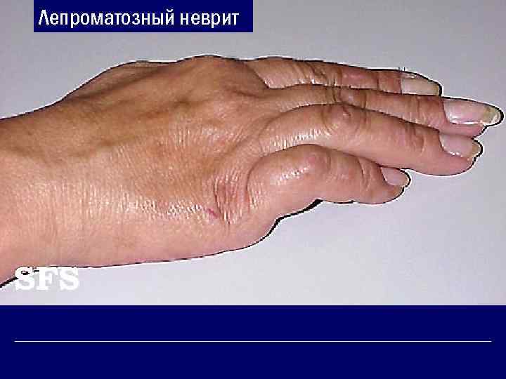 Лепроматозный неврит 