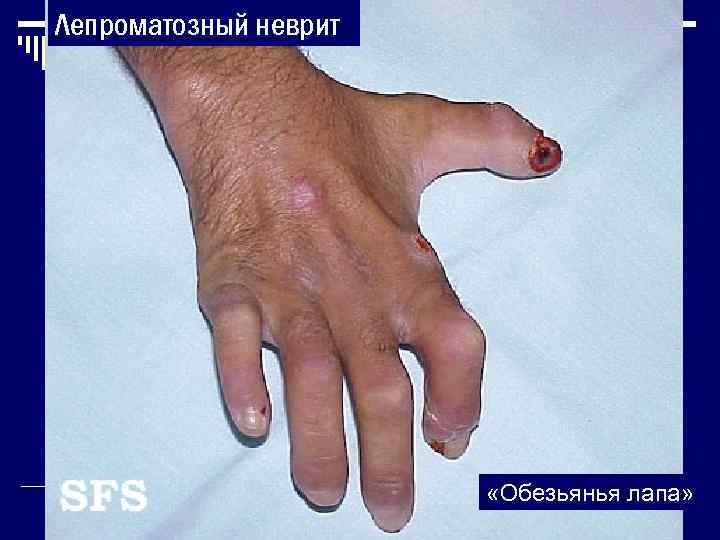 Лепроматозный неврит     «Обезьянья лапа» 