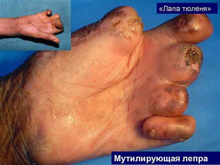    «Лапа тюленя» Мутилирующая лепра 