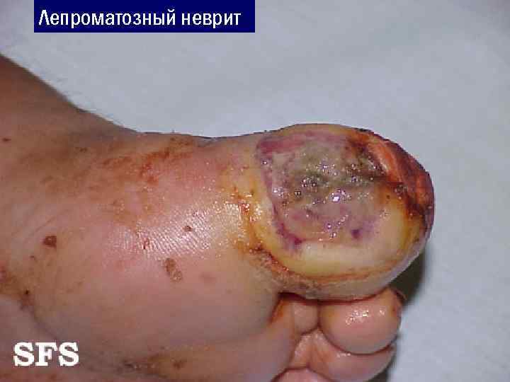 Лепроматозный неврит 