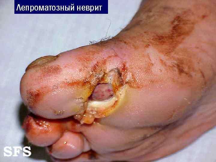 Лепроматозный неврит 