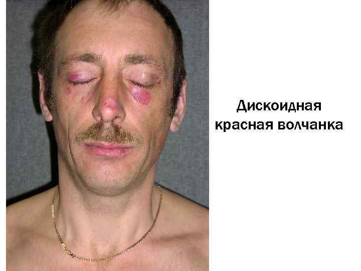   Дискоидная красная волчанка 