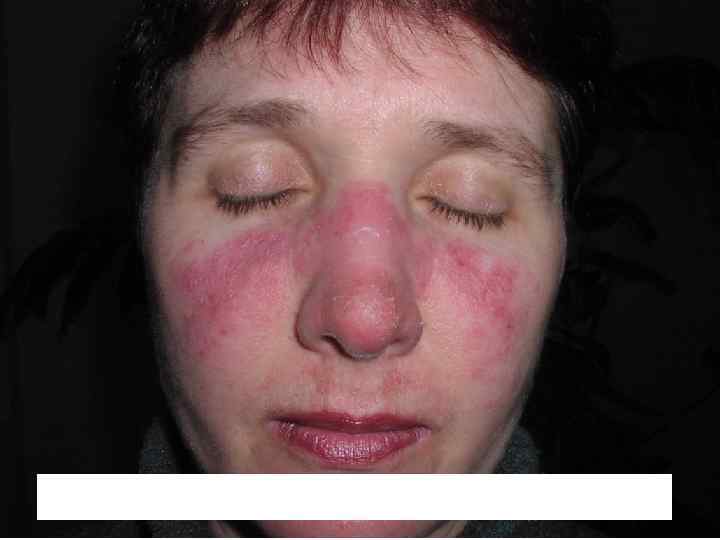 Дискоидная красная волчанка 