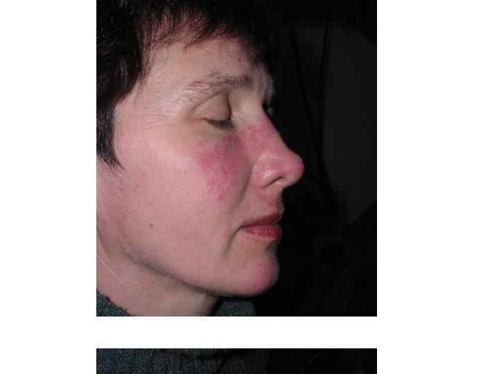 Дискоидная красная волчанка 