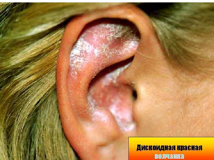 Дискоидная красная волчанка 