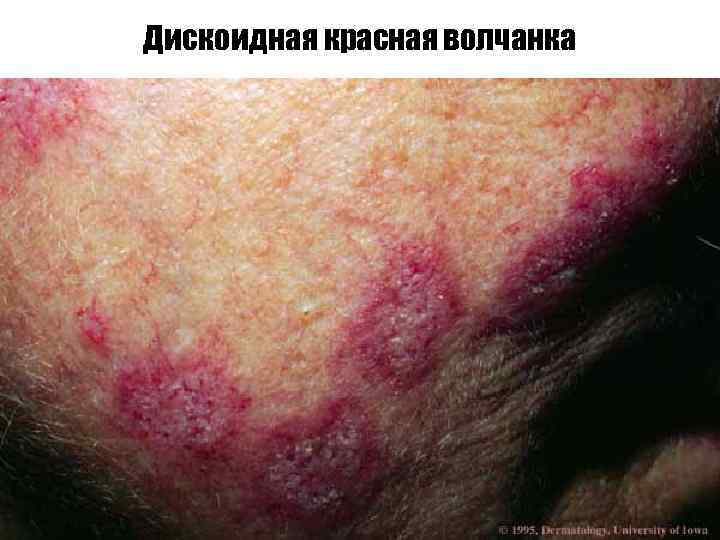 Дискоидная красная волчанка 