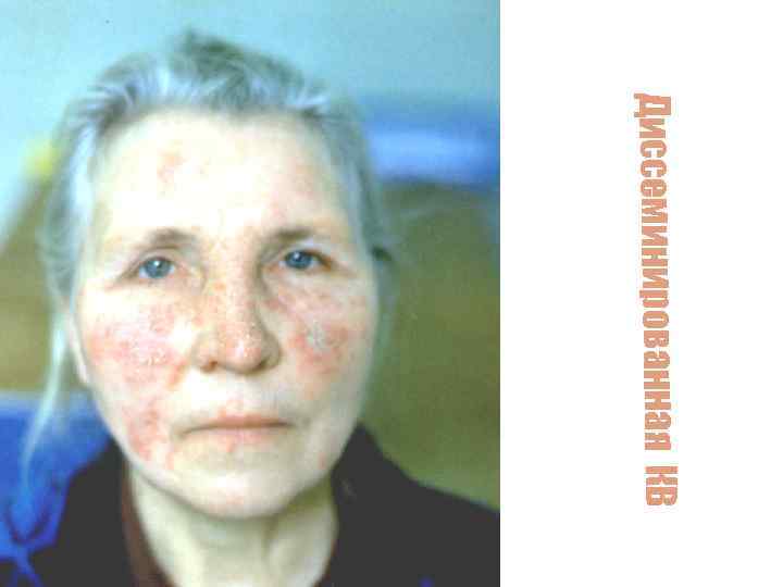 Диссеминированная КВ 