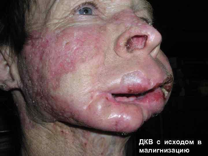 ДКВ с исходом в малигнизацию 