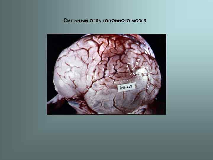Сильный отек головного мозга 