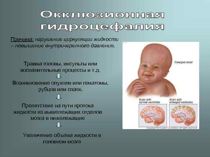 Причина: нарушение циркуляции жидкости – повышение внутричерепного давления.  Травма головы, инсульты или воспалительные