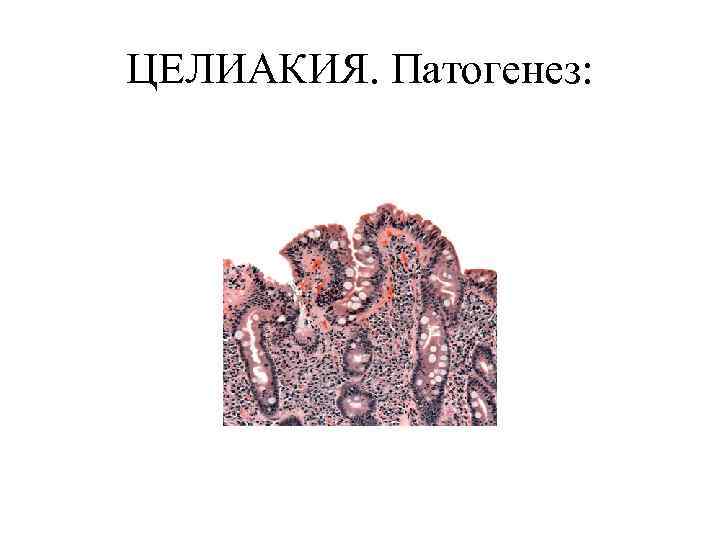 ЦЕЛИАКИЯ. Патогенез: 