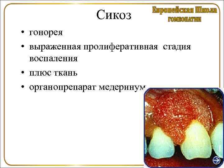     Сикоз • гонорея • выраженная пролиферативная стадия  воспаления •