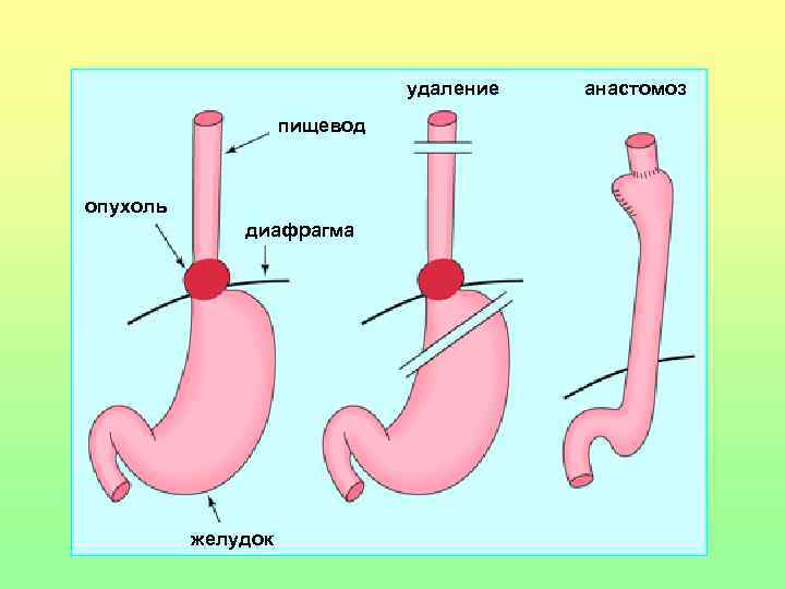 удаление анастомоз пищевод удаление анастомоз пищевод