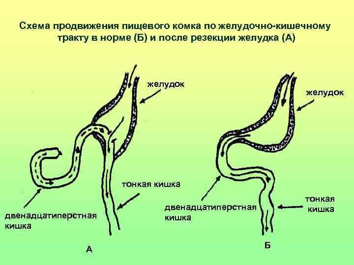 Схема продвижения пищевого комка по желудочно-кишечному тракту в норме (Б) и Схема продвижения пищевого комка по желудочно-кишечному тракту в норме (Б) и