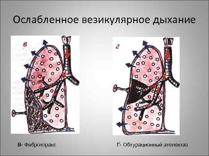 Ослабленное везикулярное дыхание В- Фиброторакс  Г- Обтурационный ателектаз 