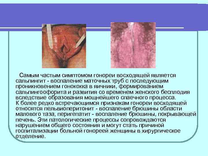  Самым частым симптомом гонореи восходящей является сальпингит - воспаление маточных труб с последующим