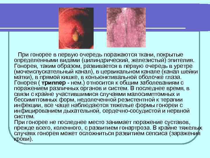  При гонорее в первую очередь поражаются ткани, покрытые определенными видами (цилиндрический, железистый) эпителия.