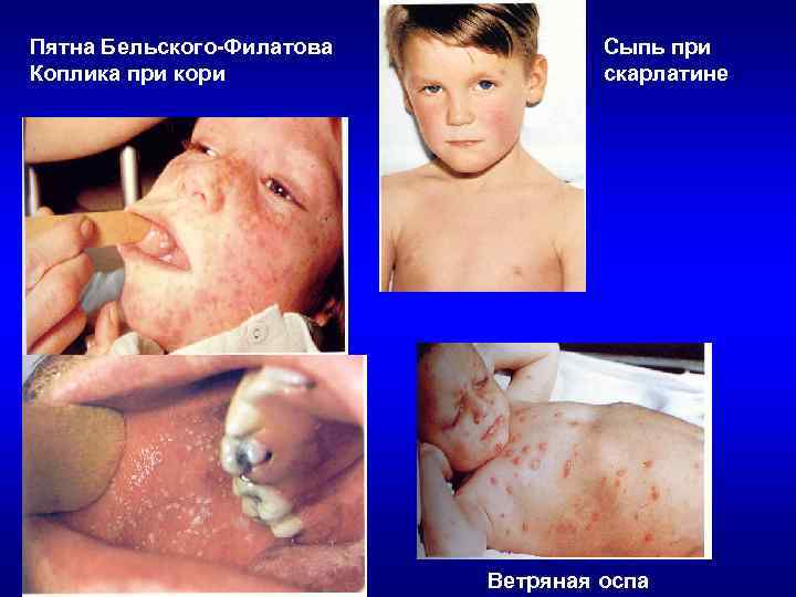 Пятна Бельского-Филатова  Сыпь при Коплика при кори    скарлатине  