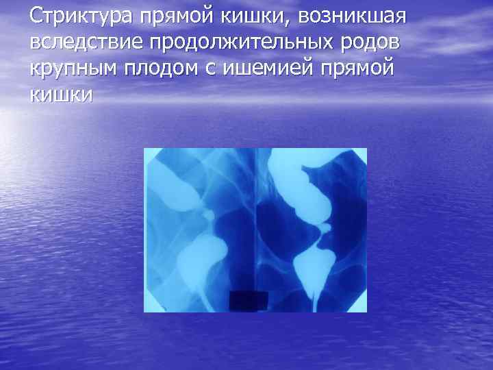 Стриктура прямой кишки, возникшая вследствие продолжительных родов крупным плодом с ишемией прямой кишки 