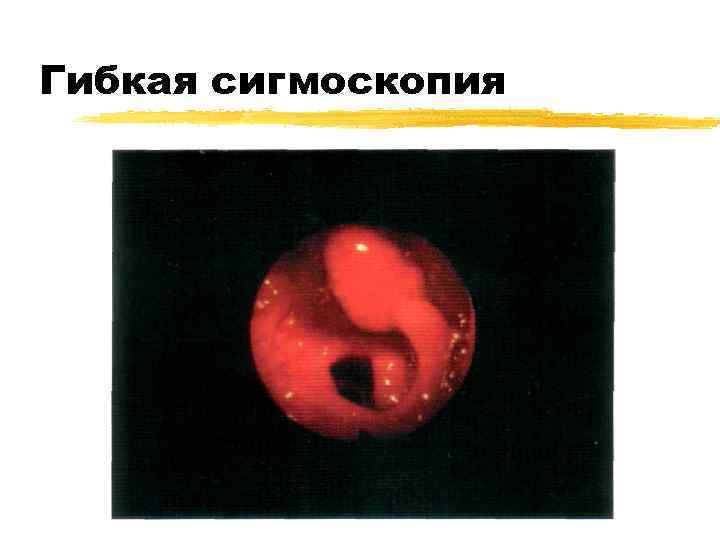 Гибкая сигмоскопия 