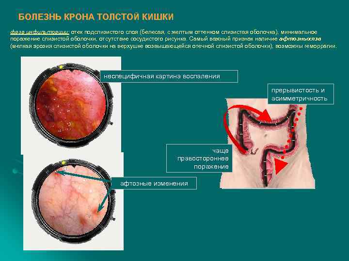  БОЛЕЗНЬ КРОНА ТОЛСТОЙ КИШКИ фаза инфильтрации: отек подслизистого слоя (белесая, с желтым оттенком