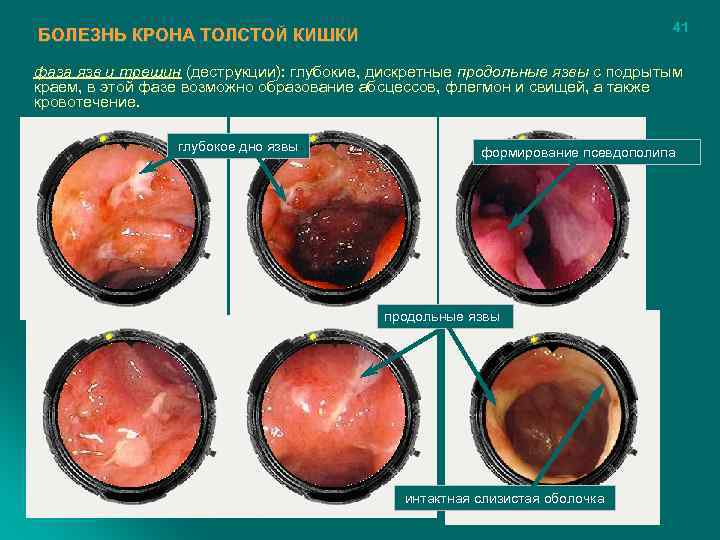        41 БОЛЕЗНЬ КРОНА ТОЛСТОЙ КИШКИ фаза язв