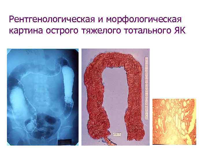 Рентгенологическая и морфологическая картина острого тяжелого тотального ЯК 