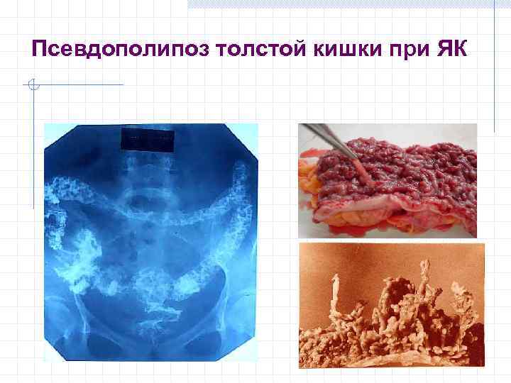 Псевдополипоз толстой кишки при ЯК 