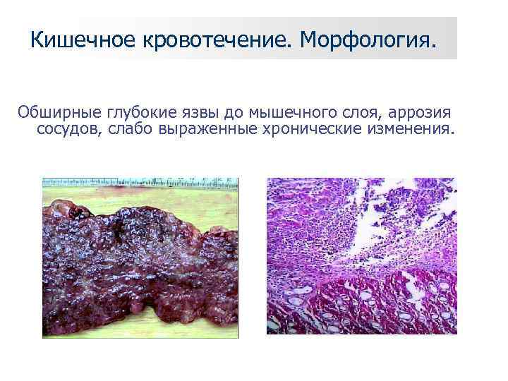  Кишечное кровотечение. Морфология.  Обширные глубокие язвы до мышечного слоя, аррозия  сосудов,